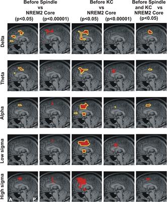 The Emergence of Spindles and K-Complexes and the Role of the Dorsal Caudal Part of the Anterior Cingulate as the Generator of K-Complexes